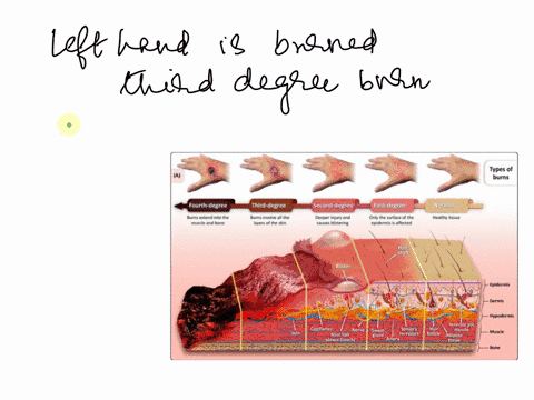 craigs-left-hand-is-more-damaged-and-the-emts-believe-it-is-third-degree-burn-if-they-are-correct-which-layers-are-damaged-epidermis-and-hypodermis-epidermis-dermis-and-underlying-tissues-de-78892
