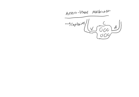 which-of-the-following-most-appropriately-describes-the-pathophysiology-of-arterio-venous-malformation-avm-group-of-answer-choices-interruption-of-intestinal-blood-flow-by-embolism-thrombosis-or-a-low