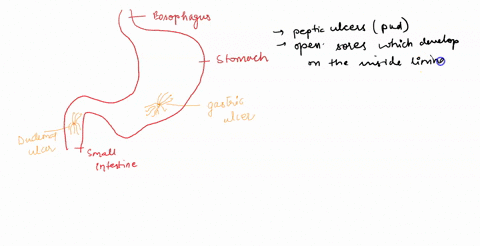 a-nurse-is-instructing-a-client-with-peptic-ulcer-disease-pud-about-the-diet-that-should-be-followed-during-the-acute-phase-which-type-of-diet-should-the-nurse-stress-03304