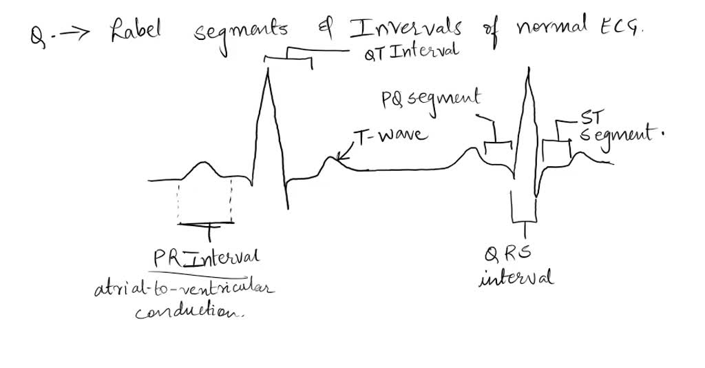 Interpret the components of a normal ECG pattern with a time scale by ...