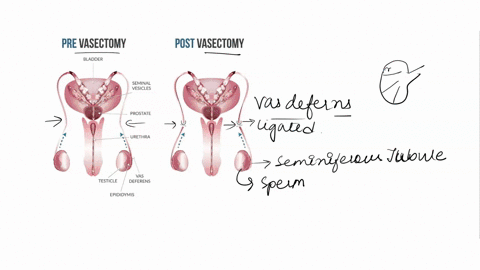 3-answer-the-following-questions-31-during-vasectomy-which-structure-will-be-cut-or-ligated-why-will-this-prevent-pregnancy-during-vasectomy-the-vas-deferens-tubes-are-tied-cut-clipped-or-se-80546