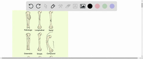 the-fracture-type-in-which-the-bone-ends-are-incompletely-separated-is-a-greenstick-b-compound-c-sim