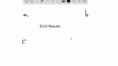 which-portion-of-the-ecg-corresponds-to-11-which-portion-of-the-ecg-corresponds-repolarization-of-th