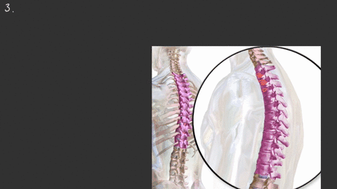 osteoporosis-is-a-common-age-related-bone-disease-in-which-bone-density-and-strength-is-decreased-wa