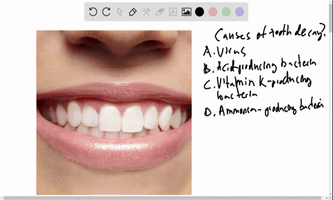 what-is-the-likely-cause-of-tooth-decay-a-a-lysogenic-virus-infecting-the-living-cells-of-the-tooth-