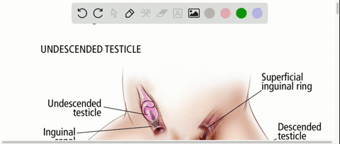 which-will-occur-as-a-result-of-nondescent-of-the-testes-a-male-sex-hormones-will-not-be-circulated-