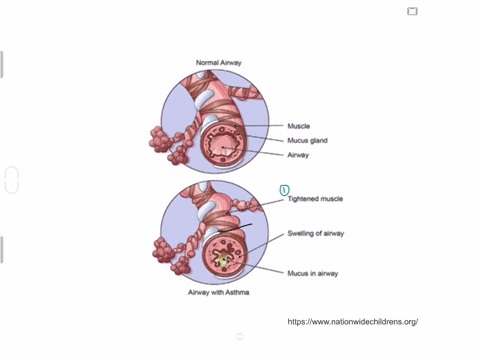 visit-this-site-httpopenstaxcollegeorglasthma-to-learn-more-about-what-happens-during-an-asthma-atta