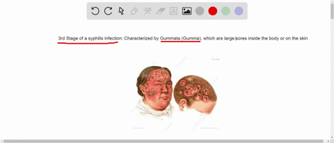 which-of-the-following-is-indicative-of-the-third-stage-of-a-syphilis-infection-a-chancre-b-rash-c-g