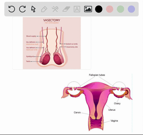 the-most-effective-method-to-prevent-fertilization-is-the-oral-contraceptive-b-the-iud-c-the-morning