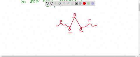 qrs-complex-represents-the-a-depolarization-of-ventricles-b-repolarization-of-ventricles-c-repolariz