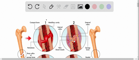 formation-of-the-bony-callus-in-fracture-repair-is-followed-by-a-hematoma-formation-b-fibrocartilagi