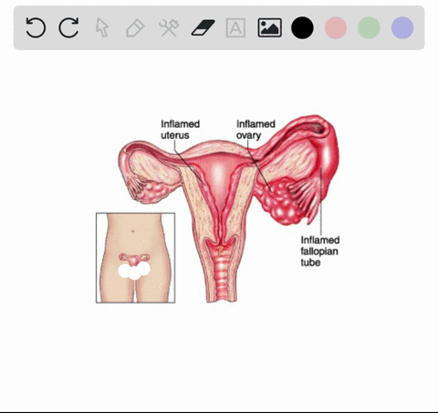 pelvic-inflammatory-disease-is-commonly-caused-by-a-syphilis-b-gonorrhea-c-genital-herpes-d-hiv-e--5