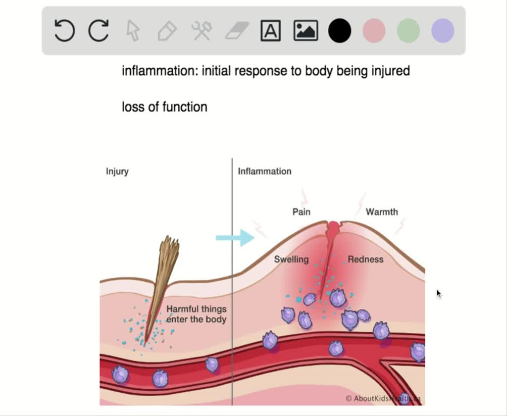 Which Of The Following Is Incorrect About Inflammation Which of the following processes is not a cardinal sign of inflammation